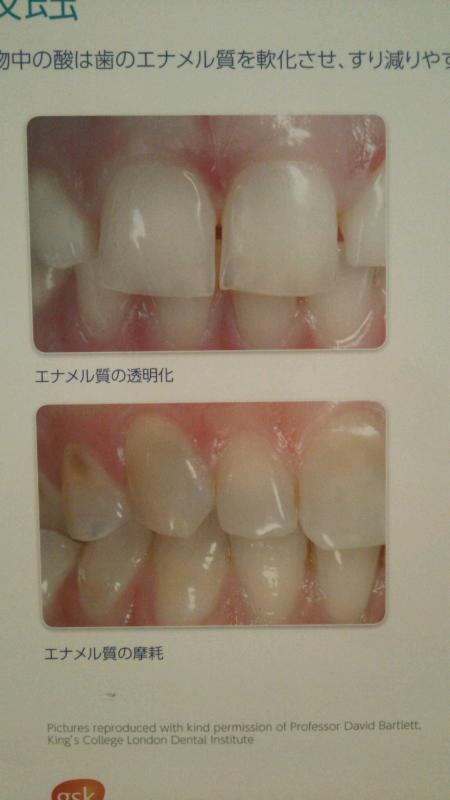 酸蝕症
