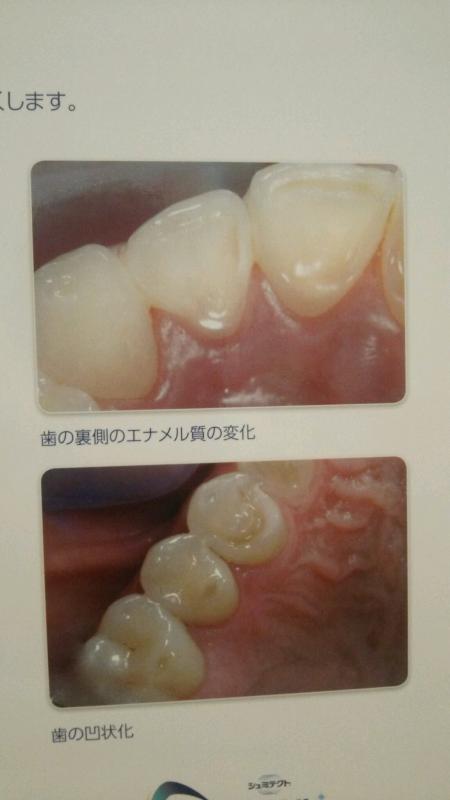 酸蝕症