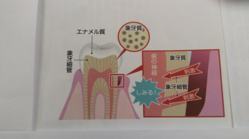 知覚過敏症